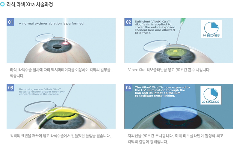 라식,라섹 Xtra 시술과정
-. 라식, 라섹수술 절차에 따라 엑시머레이저를 이용하여 각막의 일부를 깍습니다.
- Vibex Xtra 리보플라빈을 넣고 90초간 흡수 시킵니다.
-각막의 표면을 깨끗이 닦고 라식수술에서 만들었던 플랩을 덮습니다.
-자외선을 90초간 조사합니다. 이때 리보플라빈이 활성화 되고 각막의 결합이 강해집니다.