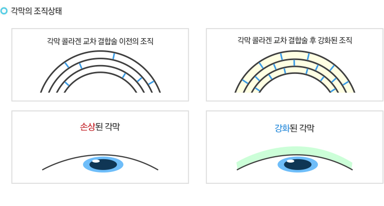 1. 라식,라섹수술 후 각막의 조직은 약해지게 됩니다. 약해진 각막을 그대로 방치하게 되면 원추각막, 근시퇴행 등 부작용이 올 수 있습니다. 라식/라섹 엑스트라는 약해진 각막을 150% 강화시켜 줍니다.
2. 라식/라섹 엑스트라는 약해진 각막 위에 비타민 B2를 도포 후 UVA를 조사해서 각막의 내구성을 강하게 만들어 수술 후 약해진 각막을 150% 튼튼하게 해 줍니다.
3. 라식/라섹 엑스트라 시술 후 튼튼해진 각막은 외부의 자극으로부터 내구성이 생겨 수술 후에 생길 수 있는 부작용의 감소는 물론 안전한 눈 건강을 지킬 수 있습니다.